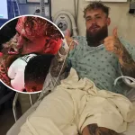 El propio Jake Paul informó a través de Instagram que la operación fue exitosa, aunque reconoció que enfrenta dolor intenso y rigidez.